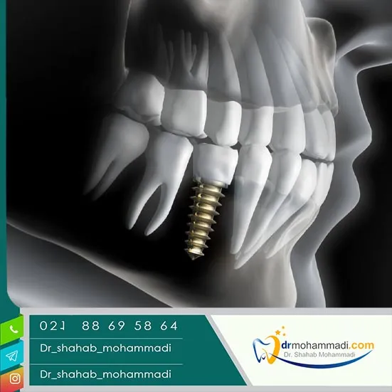 خطرات و راهکارهای کاهش ریسک ایمپلنت
